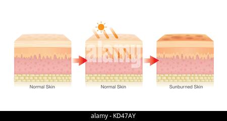Changing of human skin layer damaged from sunlight. Stock Vector