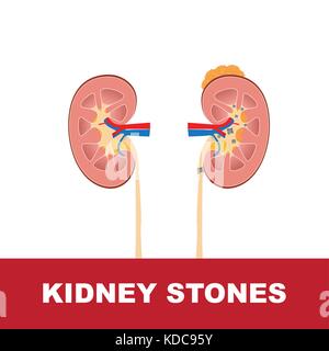 Kidney Stones Stock Vector Image & Art - Alamy