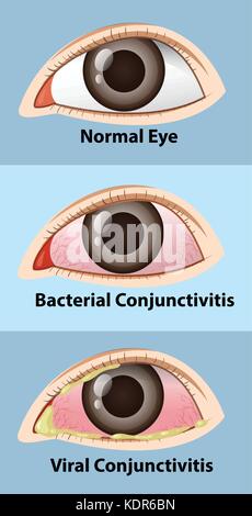 Human eye disease with viral conjunctivitis illustration Stock Vector ...