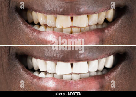 Smiling man before and after teeth whitening procedure, closeup ...