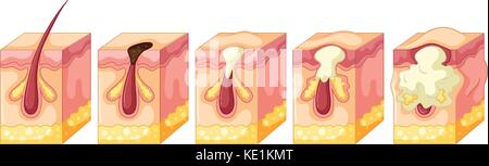 Diagram of pimple on human skin illustration Stock Vector