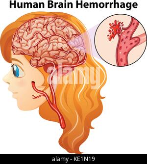 Diagram of human brain hemorrhage illustration Stock Vector Image & Art ...