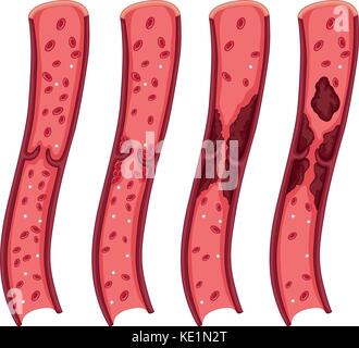 Blood clot diagram on white illustration Stock Vector