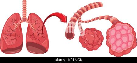 Pneumonia of the Lungs diagram illustration Stock Vector Image & Art ...