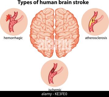 Types of human brain stroke illustration Stock Vector