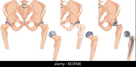 Diagram showing the hip bone treatment illustration Stock Vector