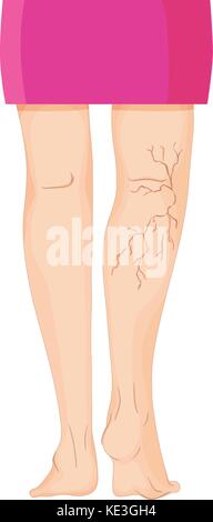 Varicose veins on human legs illustration Stock Vector