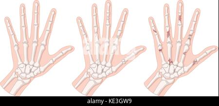 Diagram showing hand fracture illustration Stock Vector