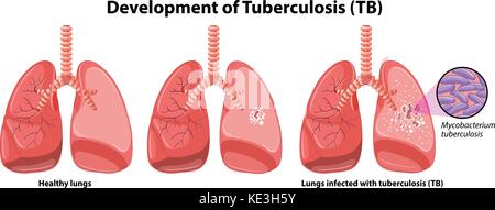 Chart showing development of tuberculosis illustration Stock Vector