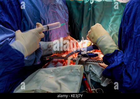 Surgeon hands are tying a knot during the open heart procedure chest during heart surgery Stock Photo