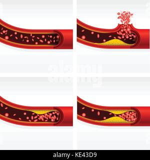 Artery section with cholesterol and thrombosis, cerebral stroke and heart attack Stock Vector