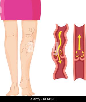 Varicose veins in human leg  illustration Stock Vector