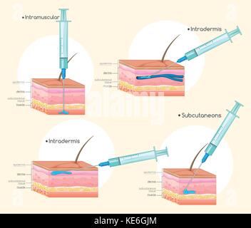 Types of Injections diagram illustration Stock Vector Image & Art - Alamy
