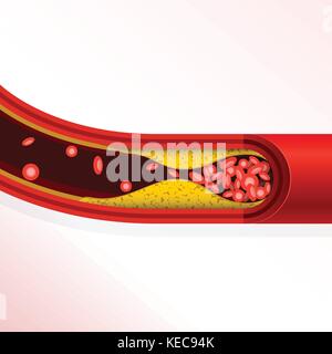 Thrombosis of artery - cholesterol buildup, arteriosclerosis Stock Vector