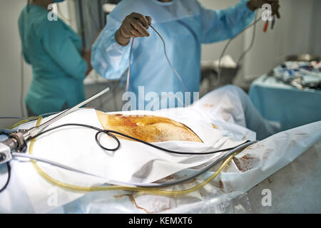 Preparation for laparoscopy operation. Patient lies on the surgical table. His stomach covered with iodine. Close Up. Horizontal. Stock Photo