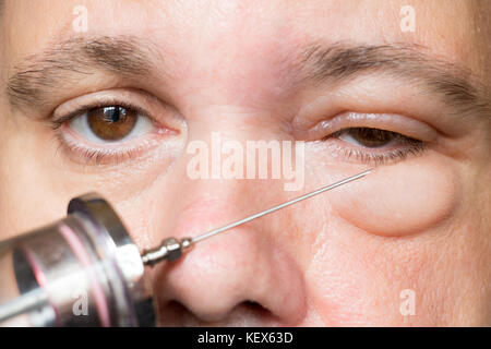 Examination of the sick eye and eyelid in the hospital. Doctor with injection treats the eyes of a man. Treatment of the diseased eye. Experiment with Stock Photo