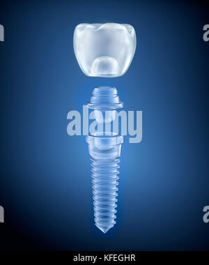 Dental titanium implant, x-ray view Stock Photo