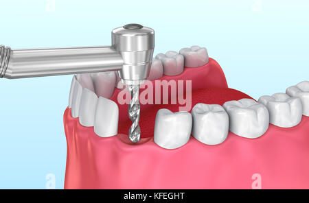 Tooth implant installation process, Medically accurate 3D illustration Stock Photo