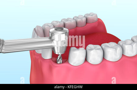 Tooth implant installation process, Medically accurate 3D illustration Stock Photo
