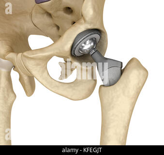 Hip replacement implant installed in the pelvis bone. Medically accurate 3D illustration Stock Photo