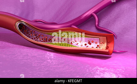 Cholesterol plaque in blood vessel , Medically accurate 3D illustration Stock Photo