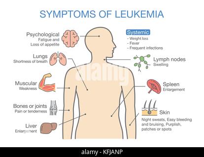 Common symptoms and signs of Leukemia. Stock Vector