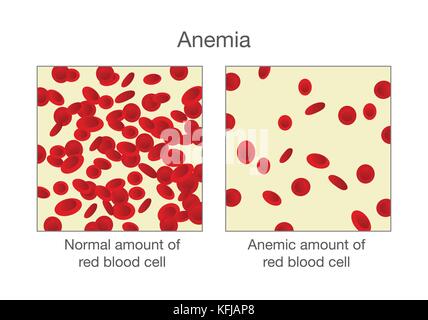 The difference of normal amount of red blood cell and Anemia. Stock Vector