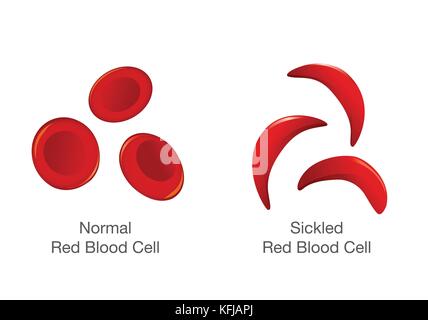 The difference of Normal red blood cell and sickle cell.