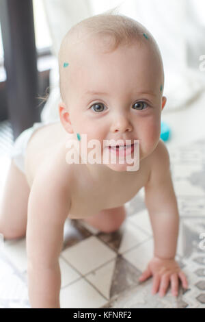 Baby with chicken pox rash Stock Photo