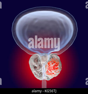 Prostate cancer. Computer illustration of a cancerous tumour (centre right) in the prostate gland (white, centre). The urethra can be seen running down the centre of the prostate, from the bladder (top). Prostate cancer is one of the most common male cancers, usually affecting the elderly. The growth of a prostate tumour can obstruct the neck of the bladder, impairing urination. However, it is a slow-growing cancer. If diagnosed, treatment involves surgery to remove the prostate gland, or radiotherapy. Stock Photo