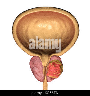 Prostate cancer. Computer illustration of a cancerous tumour (centre right) in the prostate gland (pink, centre). The urethra can be seen running down the centre of the prostate, from the bladder (top). Prostate cancer is one of the most common male cancers, usually affecting the elderly. The growth of a prostate tumour can obstruct the neck of the bladder, impairing urination. However, it is a slow-growing cancer. If diagnosed, treatment involves surgery to remove the prostate gland, or radiotherapy. Stock Photo