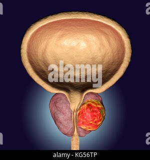 Prostate cancer. Computer illustration of a cancerous tumour (centre right) in the prostate gland (pink, centre). The urethra can be seen running down the centre of the prostate, from the bladder (top). Prostate cancer is one of the most common male cancers, usually affecting the elderly. The growth of a prostate tumour can obstruct the neck of the bladder, impairing urination. However, it is a slow-growing cancer. If diagnosed, treatment involves surgery to remove the prostate gland, or radiotherapy. Stock Photo