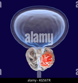Prostate cancer. Computer illustration of a cancerous tumour (centre right) in the prostate gland (white, centre). The urethra can be seen running down the centre of the prostate, from the bladder (top). Prostate cancer is one of the most common male cancers, usually affecting the elderly. The growth of a prostate tumour can obstruct the neck of the bladder, impairing urination. However, it is a slow-growing cancer. If diagnosed, treatment involves surgery to remove the prostate gland, or radiotherapy. Stock Photo