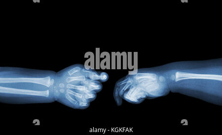Baby 's hands x-ray and blank area at upper side . ( Shake hands ) . Isolated . Stock Photo