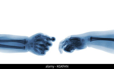 Baby 's hands x-ray and blank area at upper side . ( Shake hands ) . Isolated . Stock Photo