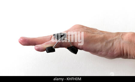 Finger splint on a little "pinkie" finger after Dupuytren's Contracture corrective surgery to straighten finger and remove scar tissue. Stock Photo