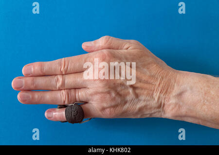 Finger splint on a little "pinkie" finger after Dupuytren's Contracture corrective surgery to straighten finger and remove scar tissue. Stock Photo