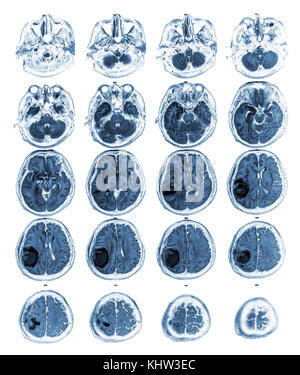 MRI brain show Brain tumor at right parietal lobe . Stock Photo