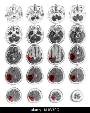 MRI brain show Brain tumor at right parietal lobe . Stock Photo