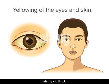 Yellowing of the eyes and skin. Stock Vector