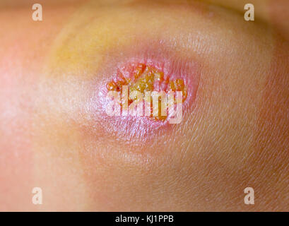 Purulent wound on the knee Stock Photo