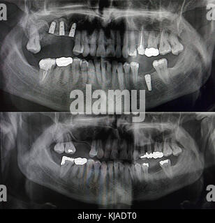 X-ray showing patients teeth before and after placement of four metal dental implants Stock Photo