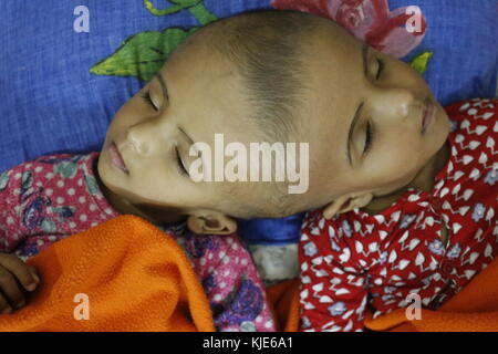 Dhaka, Bangladesh. 22nd Nov, 2017. Rabeya and Rokeya, 18 month old sister who born conjoined at head sleeping at the Dhaka Medical College Hospital (DMCH).The twins are offspring of Rafiqul Islam and Taslima Khatun from Atlongka village in Pabna's Chatmohar . Twins father Rafiqul Islam says, they have been admitted to the burn unit at the Dhaka Medical College Hospital for examination before surgery to separate their heads. Credit: Md. Mehedi Hasan/Pacific Press/Alamy Live News Stock Photo