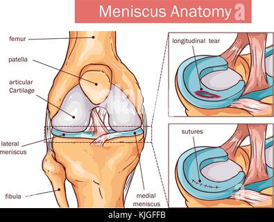 vector illustration of a Meniscus tear and surgery Stock Vector