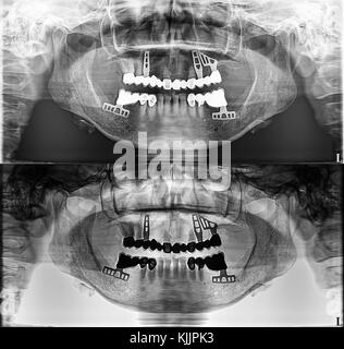 Panoramic dental Xray, fixed teeth, dental amalgam seal, dental crown and bridge, screw Stock Photo