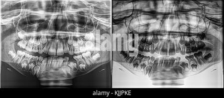 Panoramic dental Xray of a child, Deciduous - milk teeth growing from the jaw bone Stock Photo