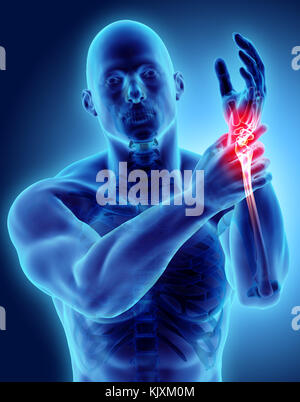 Wrist painful - skeleton x-ray, 3D Illustration medical concept. Stock Photo