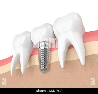 3d render of teeth with dental implant in gums over white background Stock Photo