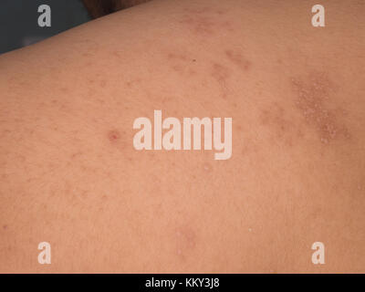 Scar after illness from Herpes zoster Stock Photo