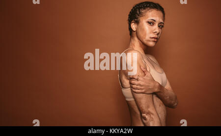 Vitiligo affected young woman standing on brown background with copy space. Female with vitiligo looking at camera. Stock Photo